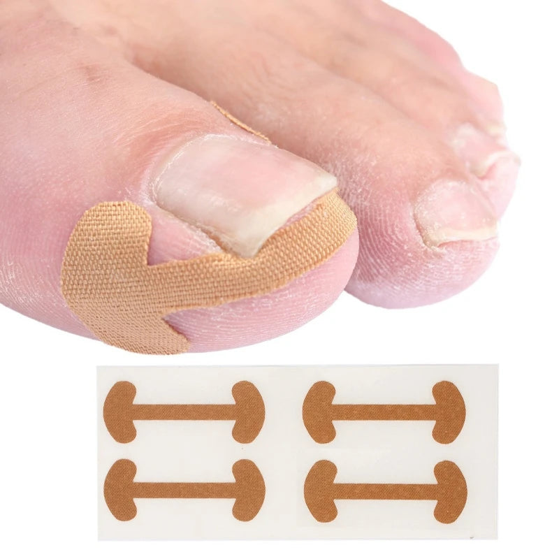 Corretor de Unha Encravada Alvion - Kit Completo Alívio Rápido Sem Cirurgia